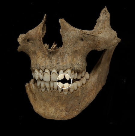 Pipe Smoking wear in the teeth of a young adult male aged 18-25 years old. Credit Jeff Veitch/Durham University.